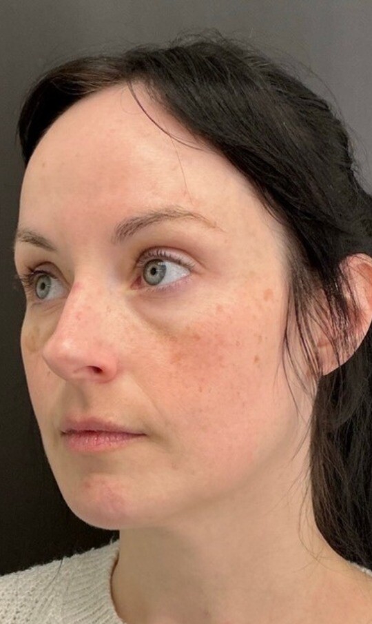 Midface: before at Chin Up Aesthetics