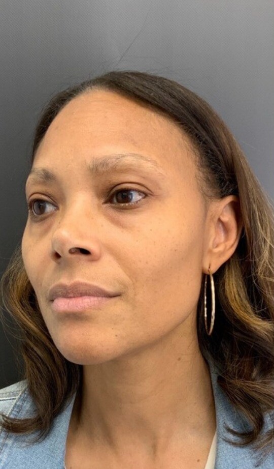 Midface: before at Chin Up Aesthetics