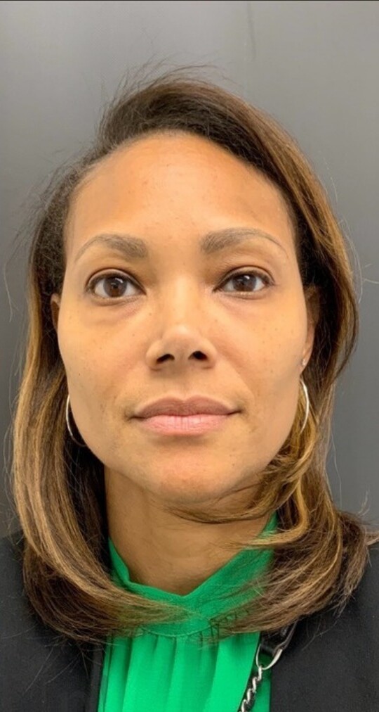 Midface & Undereye Correction: after at Chin Up Aesthetics
