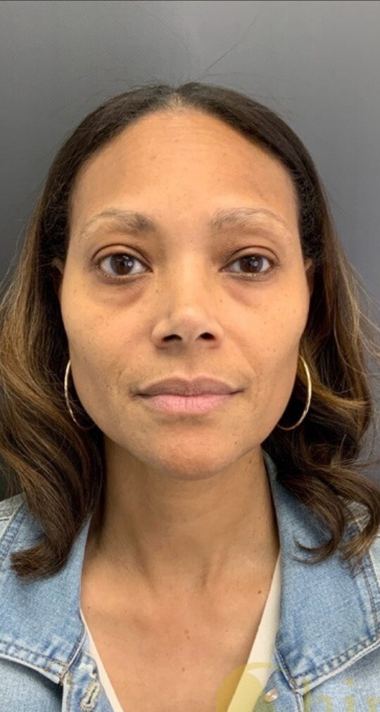 Midface & Undereye Correction: before at Chin Up Aesthetics