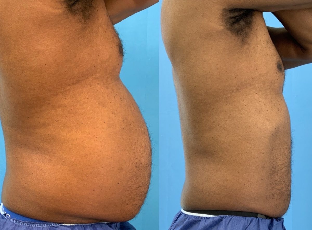 Body Contouring with Emsculpt Neo: before and after, Emsculpt Neo at Chin Up Aesthetics