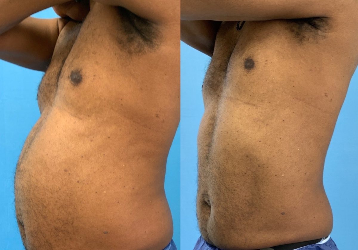 Body Contouring with Emsculpt Neo: before and after, Emsculpt Neo at Chin Up Aesthetics