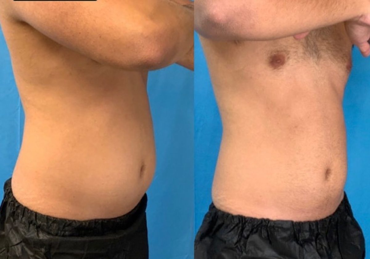 Emsculpt Neo: before and after, Emsculpt Neo at Chin Up Aesthetics