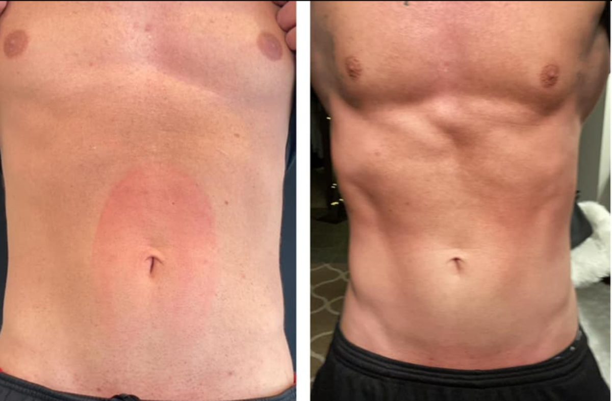 Emsculpt Neo: before and after, Emsculpt Neo at Chin Up Aesthetics