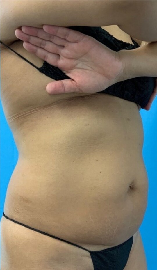 Emsella & EmSculpt Neo for Core and Body Contouring: after at Chin Up Aesthetics