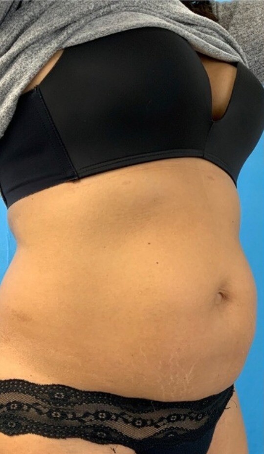 Emsella & EmSculpt Neo for Core and Body Contouring: before at Chin Up Aesthetics