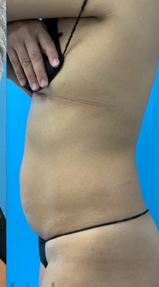 Emsella & EmSculpt Neo for Core and Body Contouring: after at Chin Up Aesthetics