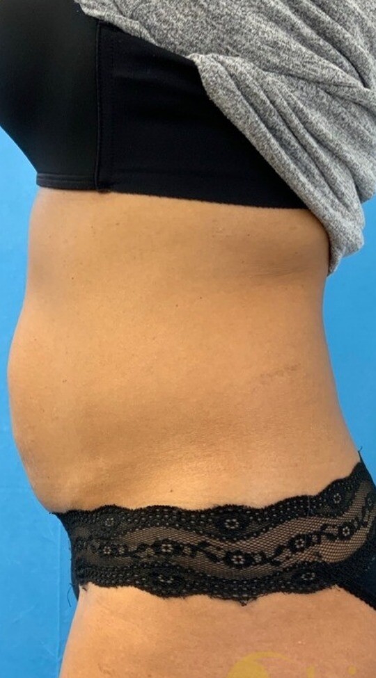 Emsella & EmSculpt Neo for Core and Body Contouring: before at Chin Up Aesthetics