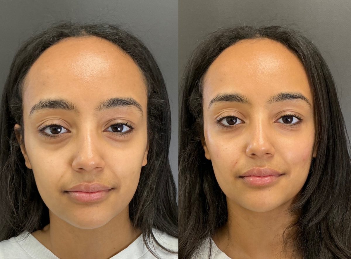 Facial Balancing: before and after, Facial Balancing at Chin Up Aesthetics
