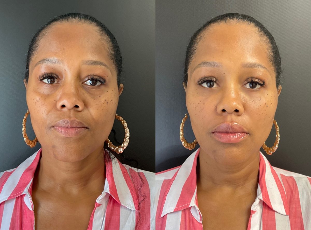 Facial Balancing: before and after, Facial Balancing at Chin Up Aesthetics
