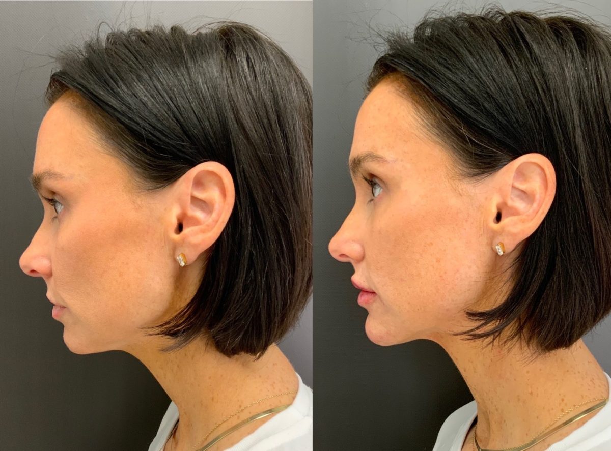 Facial Balancing: before and after, Facial Balancing at Chin Up Aesthetics