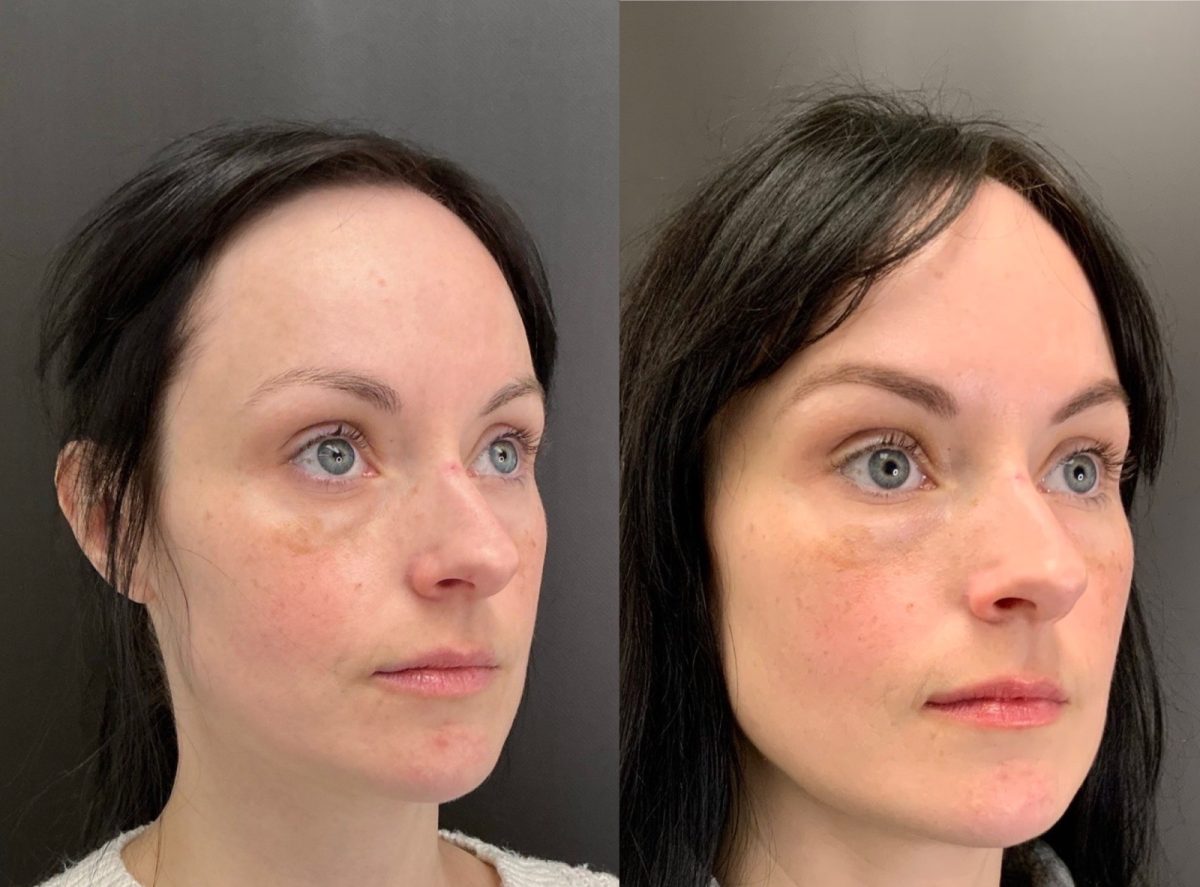 Facial Balancing: before and after, Facial Balancing at Chin Up Aesthetics