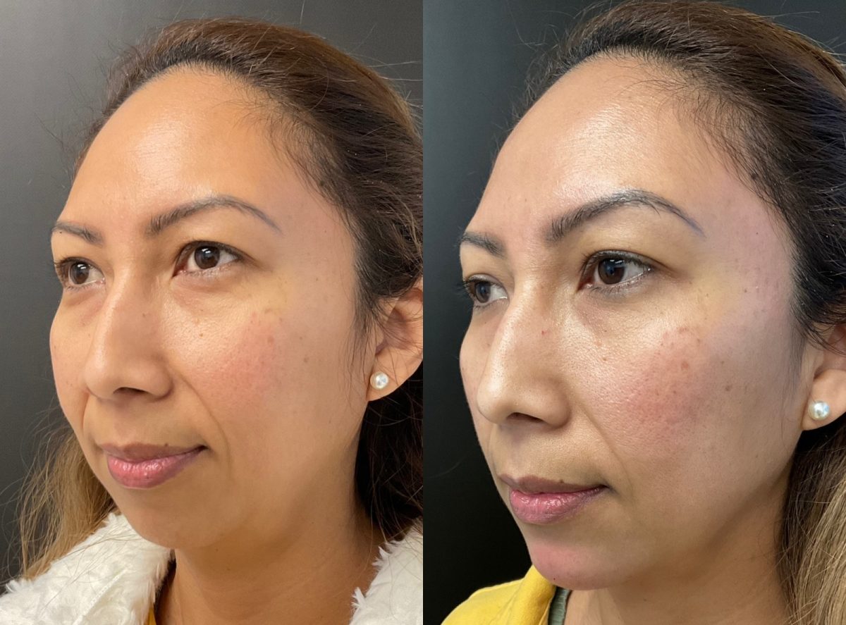 Facial Balancing: before and after, Facial Balancing at Chin Up Aesthetics