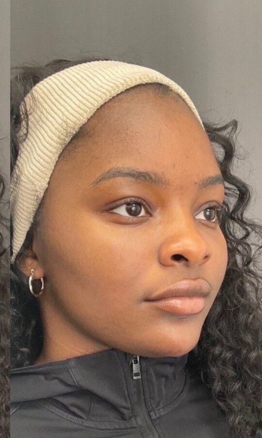 Facial Balancing: after at Chin Up Aesthetics