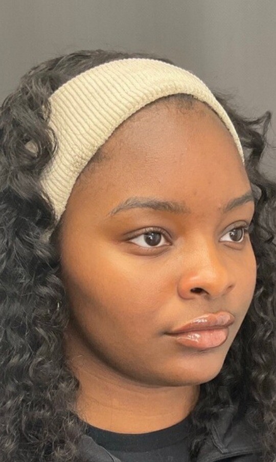 Facial Balancing: before at Chin Up Aesthetics