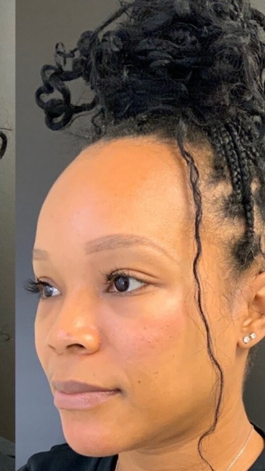 Facial Balancing: after at Chin Up Aesthetics