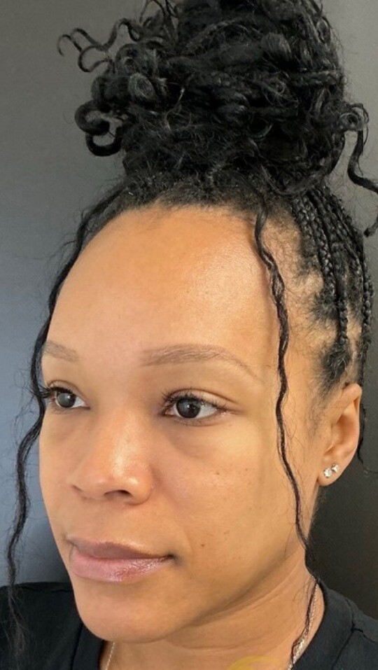 Facial Balancing: before at Chin Up Aesthetics