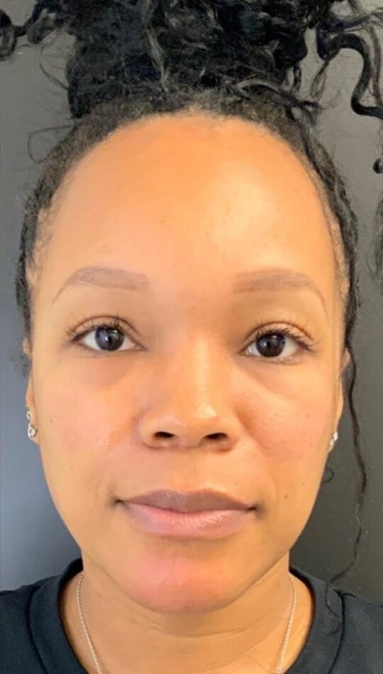 Facial Balancing: after at Chin Up Aesthetics