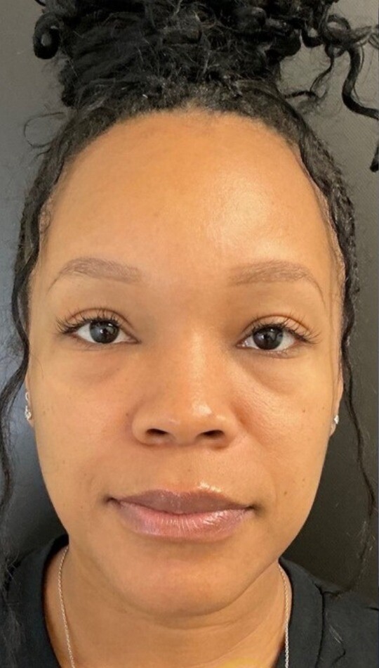 Facial Balancing: before at Chin Up Aesthetics