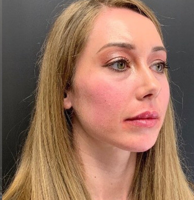 Facial Balancing: after at Chin Up Aesthetics