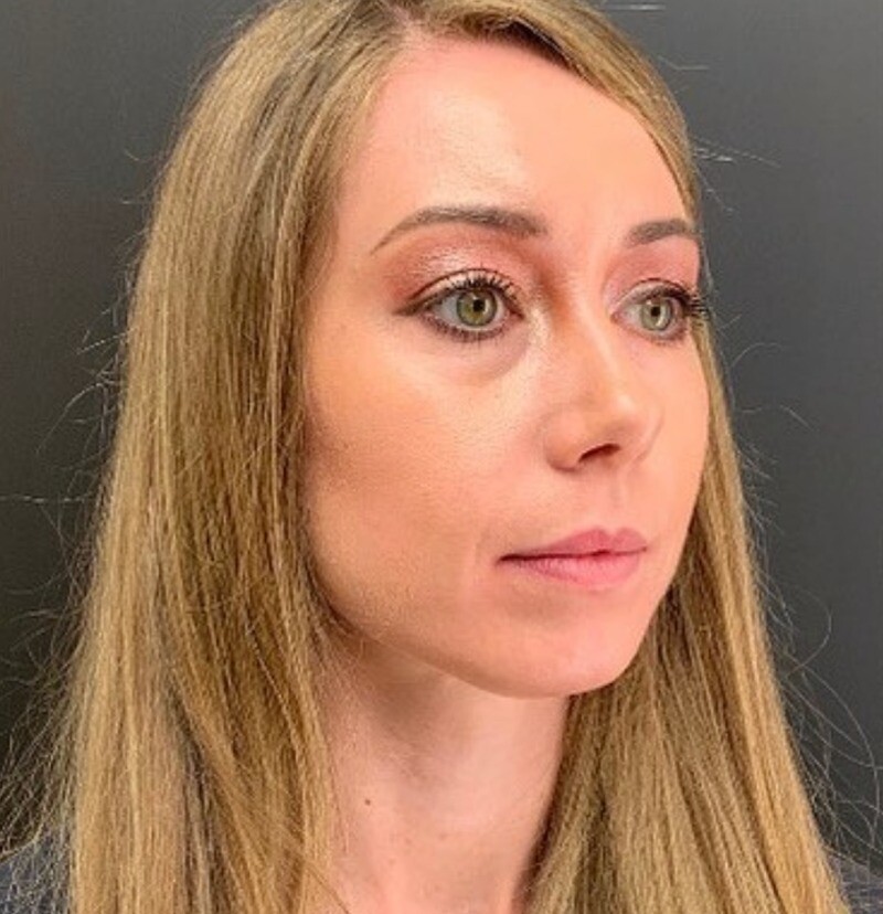 Facial Balancing: before at Chin Up Aesthetics
