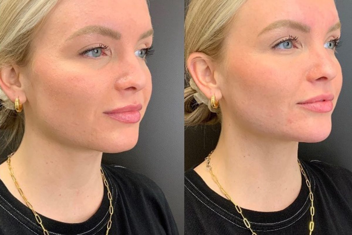 Facial Balancing: before and after, Facial Balancing at Chin Up Aesthetics