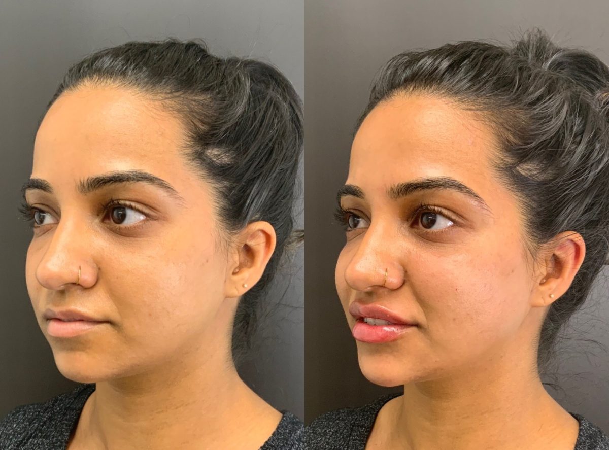 Facial Balancing: before and after, Facial Balancing at Chin Up Aesthetics