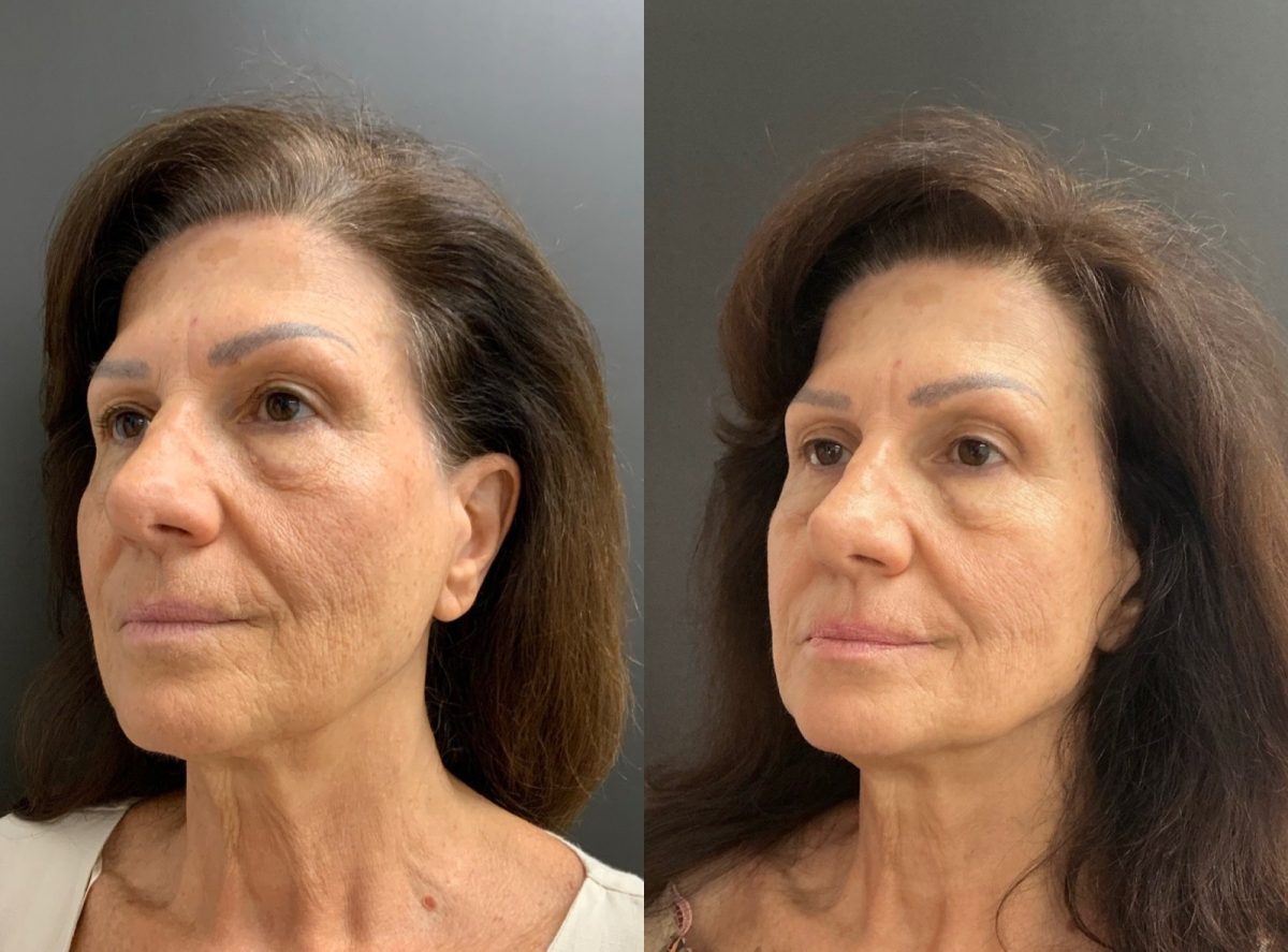 Facial Balancing: before and after, Facial Balancing at Chin Up Aesthetics