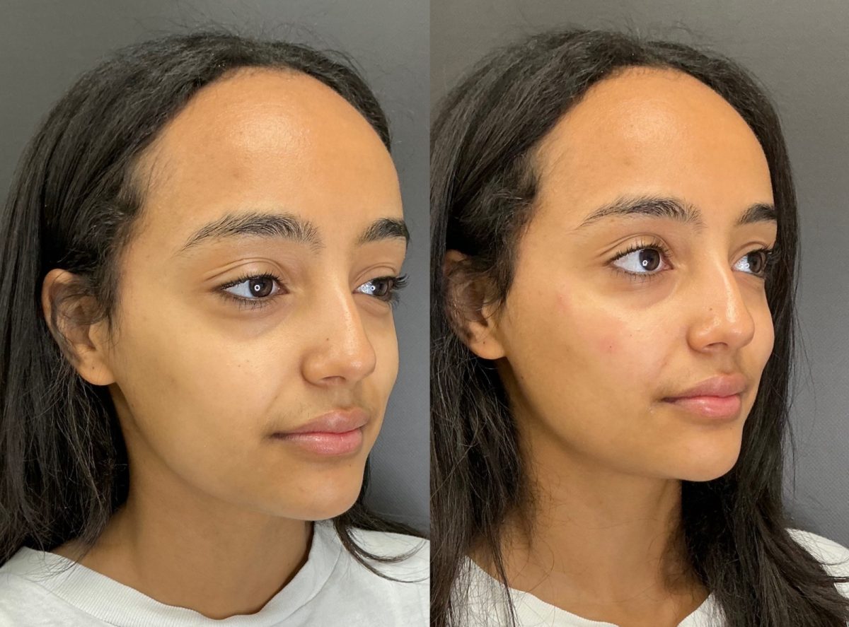 Facial Balancing: before and after, Facial Balancing at Chin Up Aesthetics