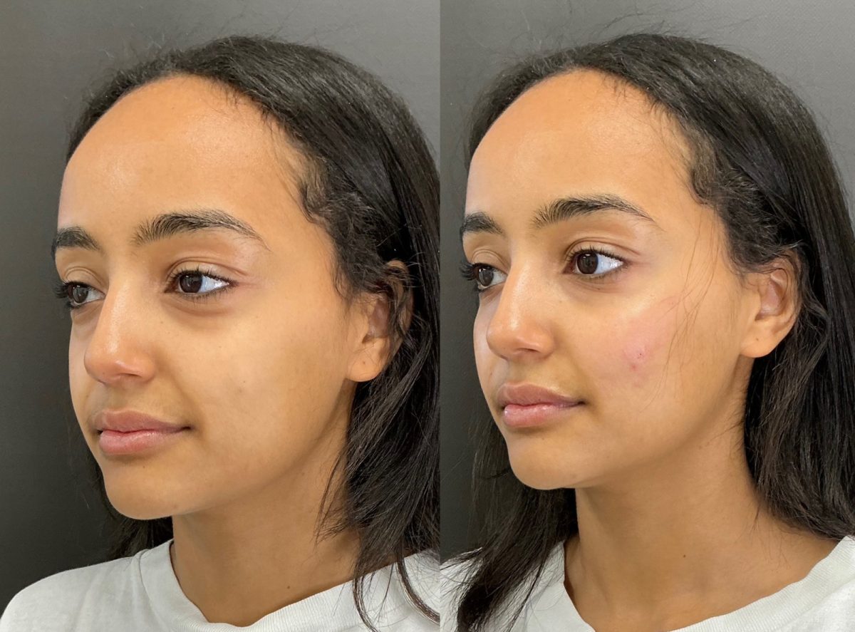 Facial Balancing: before and after, Facial Balancing at Chin Up Aesthetics