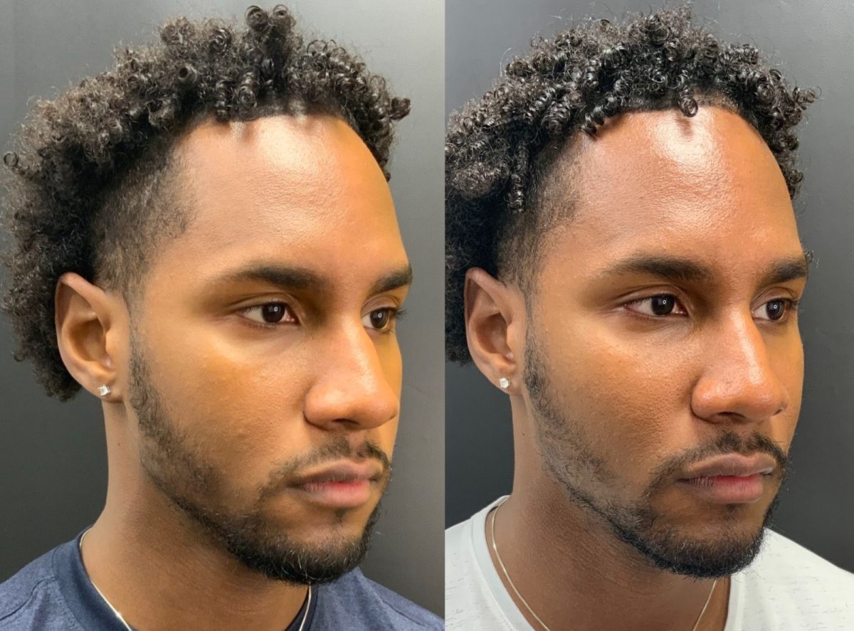 Facial Balancing: before and after, Facial Balancing at Chin Up Aesthetics
