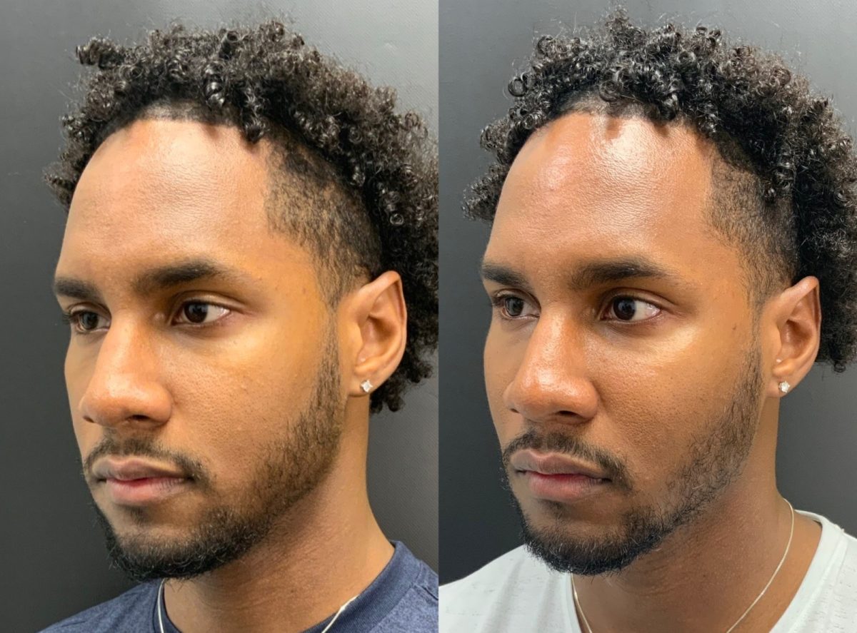 Facial Balancing: before and after, Facial Balancing at Chin Up Aesthetics