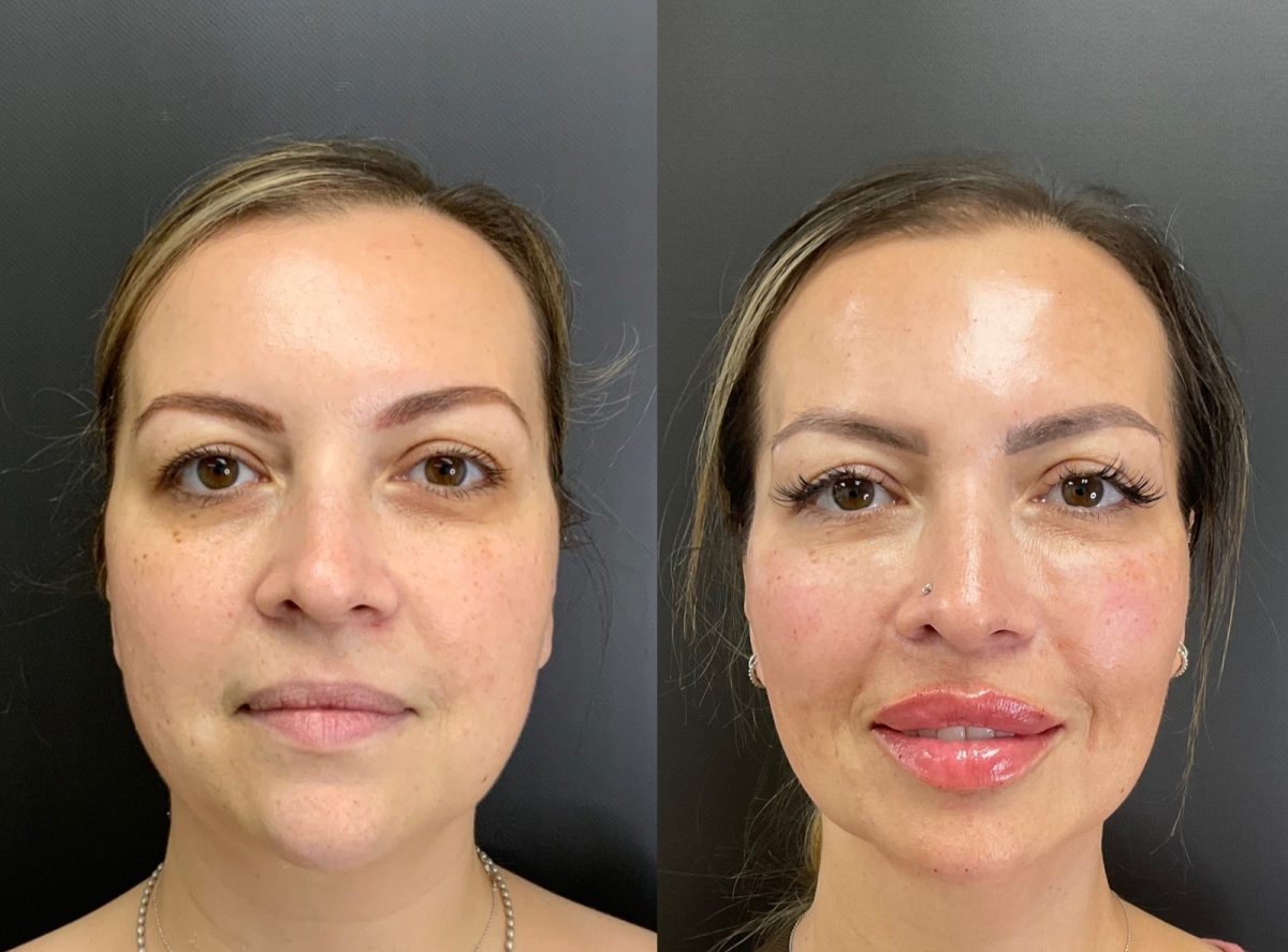 Facial Balancing: before and after, Facial Balancing at Chin Up Aesthetics
