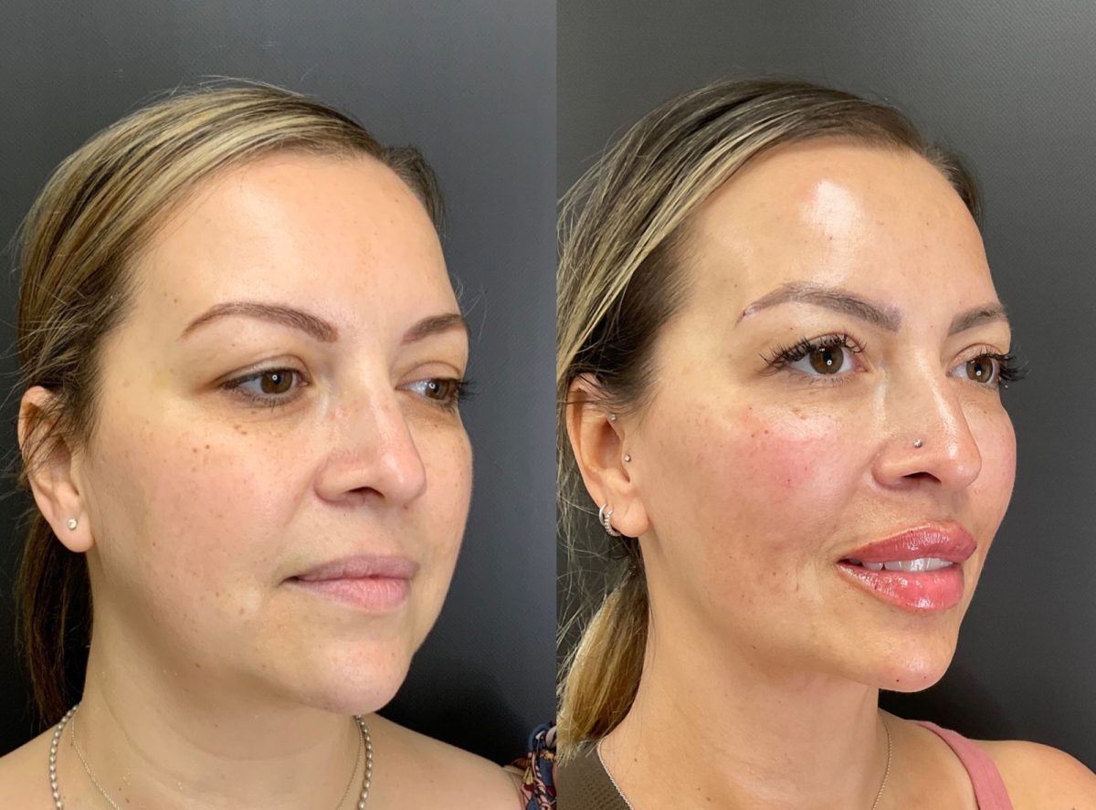 Facial Balancing: before and after, Facial Balancing at Chin Up Aesthetics