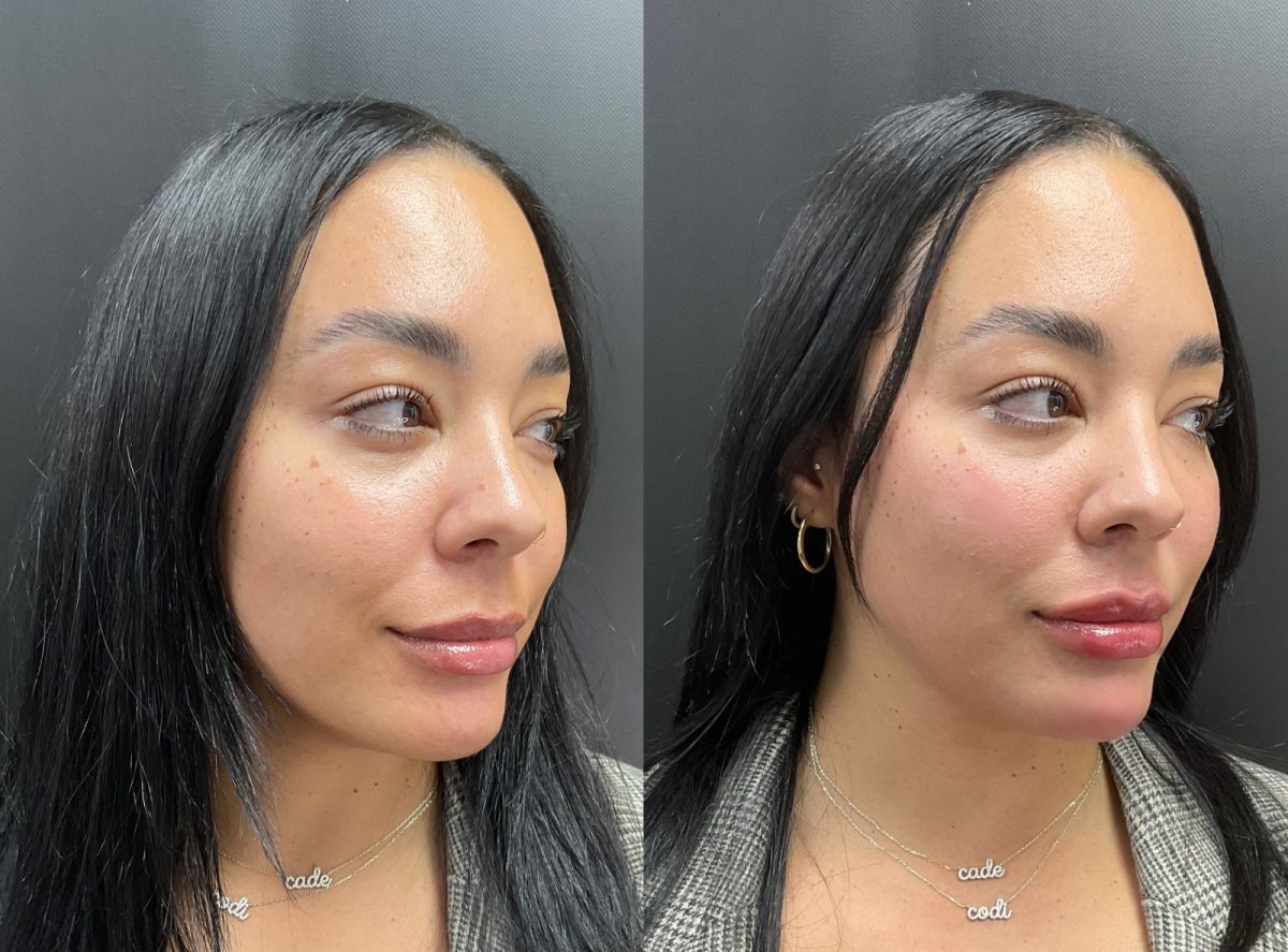 Facial Balancing: before and after, Facial Balancing at Chin Up Aesthetics