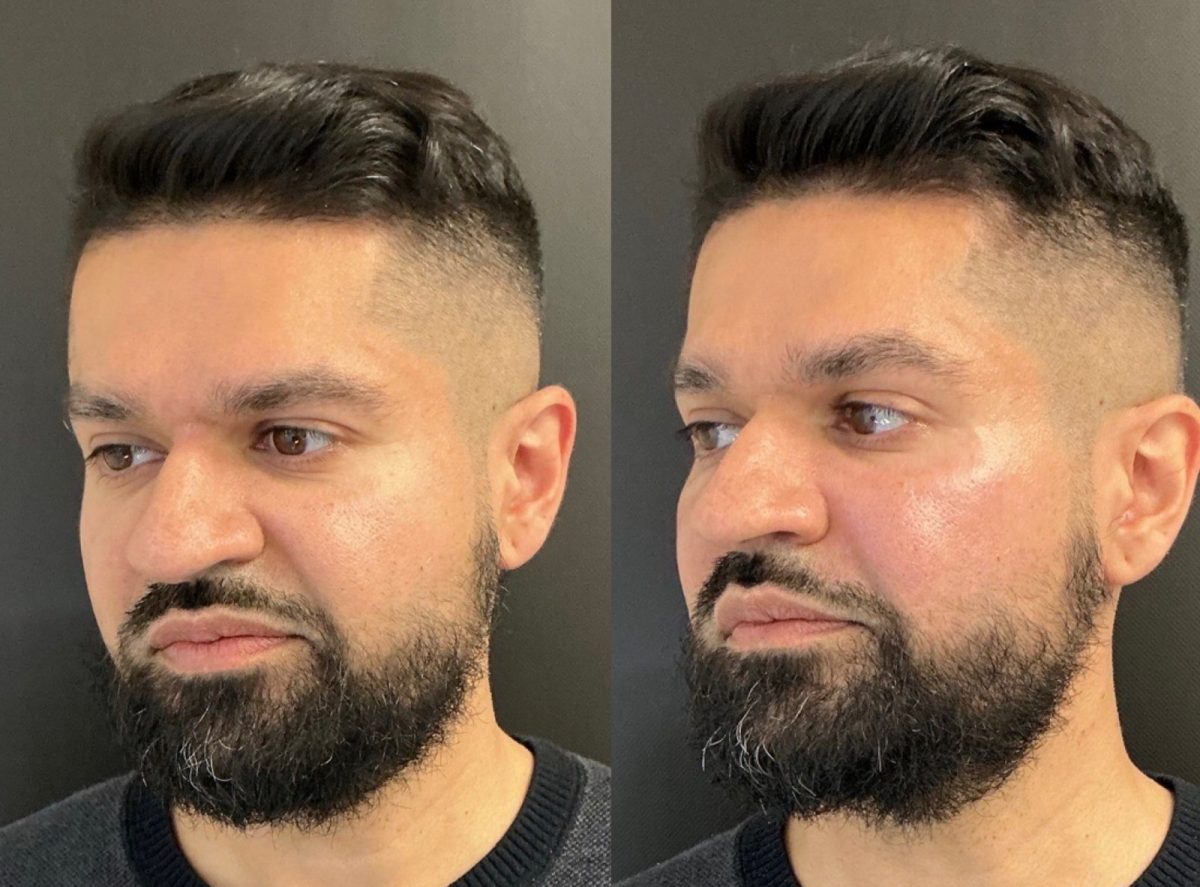 Facial Balancing: before and after, Facial Balancing at Chin Up Aesthetics