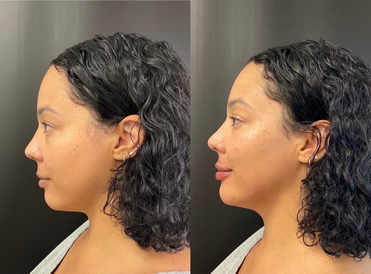 Facial Balancing: before and after, Facial Balancing at Chin Up Aesthetics