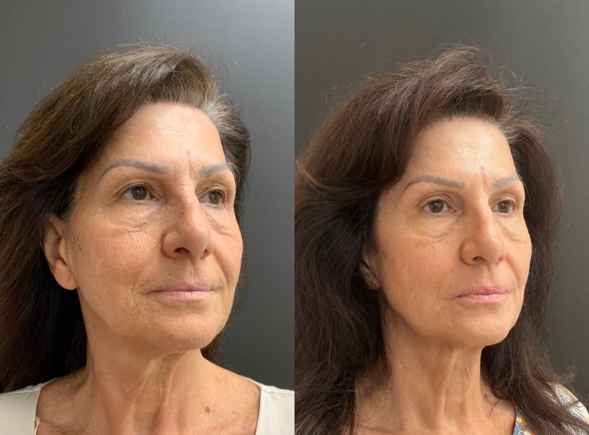 Facial Balancing: before and after, Facial Balancing at Chin Up Aesthetics