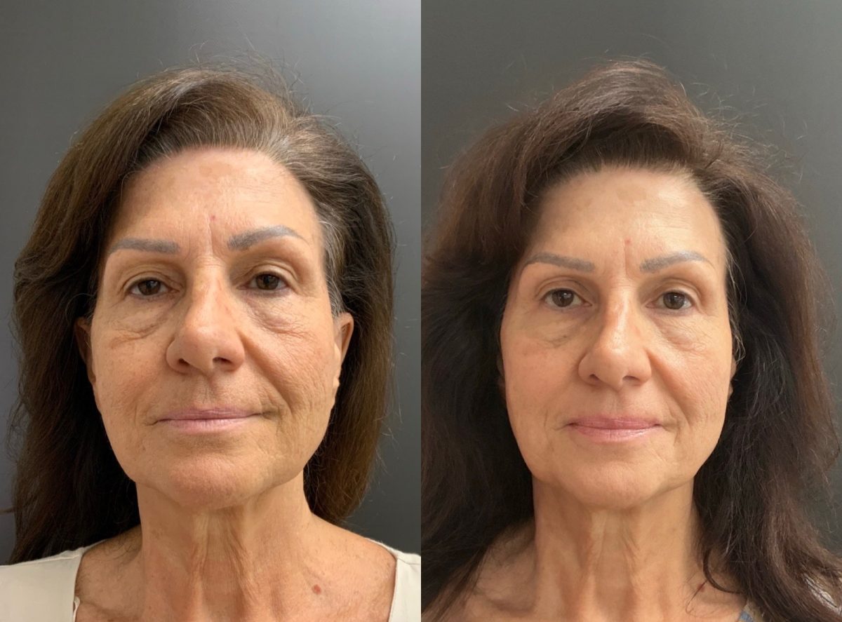 Facial Balancing: before and after, Facial Balancing at Chin Up Aesthetics