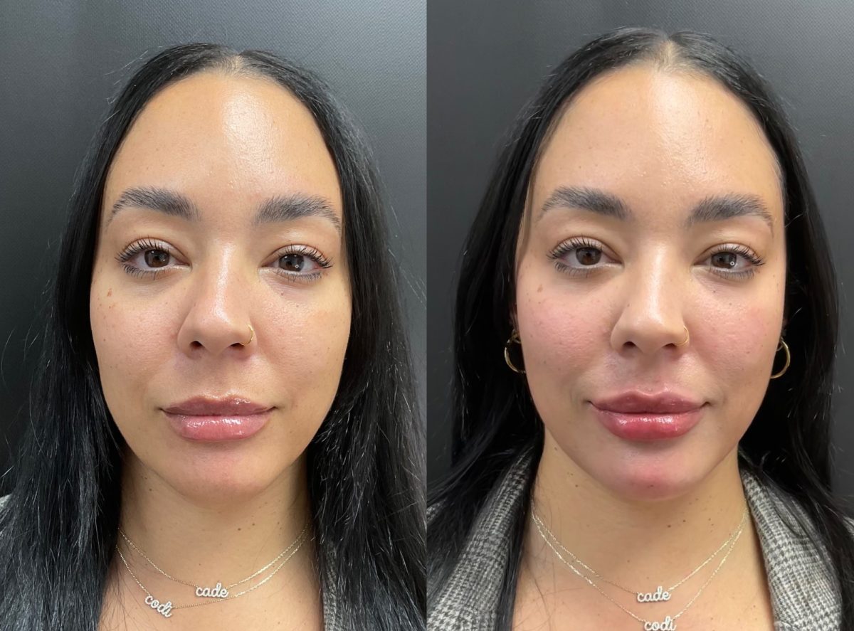 Facial Balancing: before and after, Facial Balancing at Chin Up Aesthetics