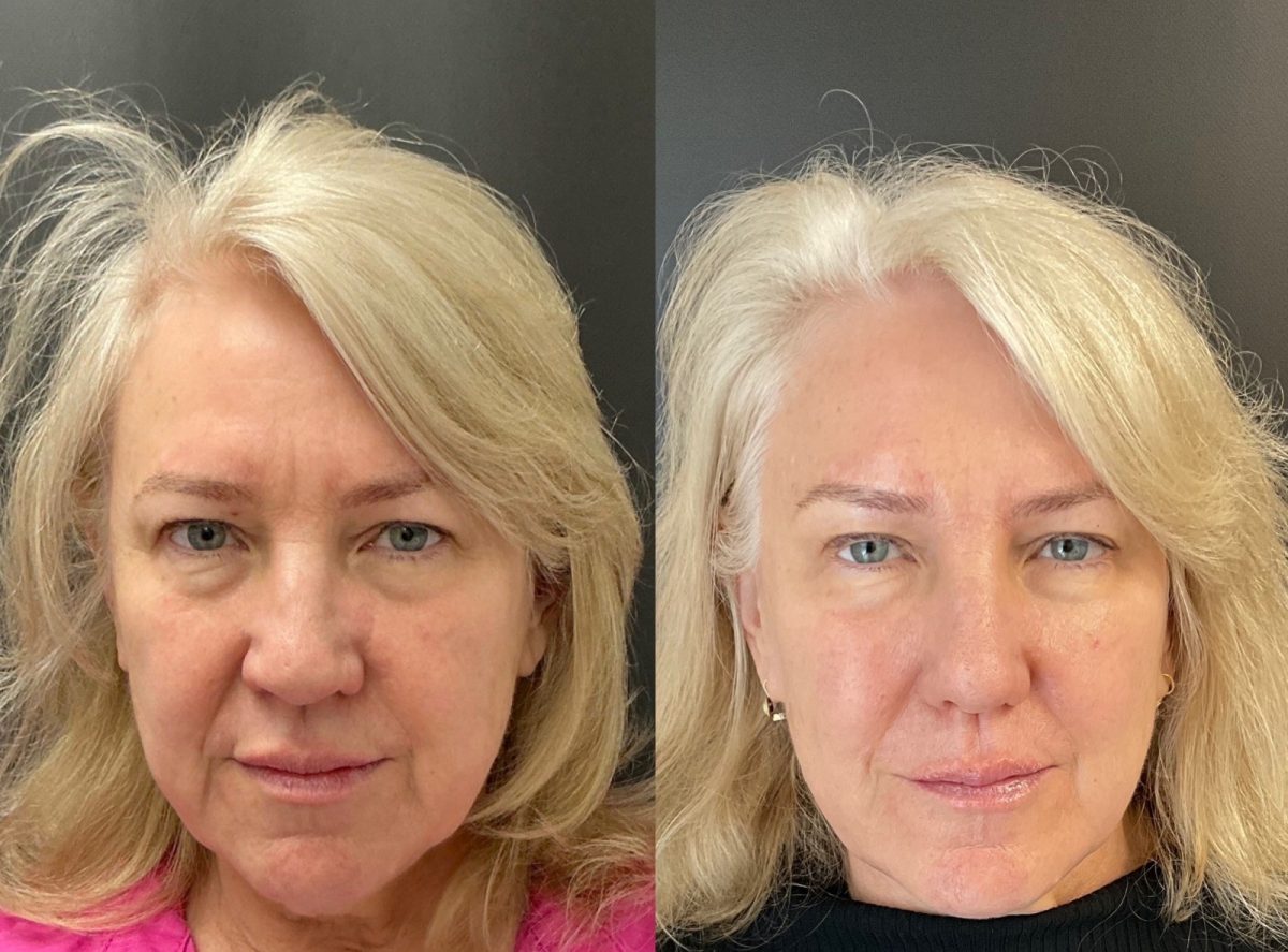 Facial Balancing: before and after, Facial Balancing at Chin Up Aesthetics