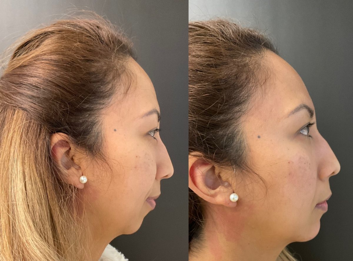 Chin Filler: before and after, Facial Balancing at Chin Up Aesthetics