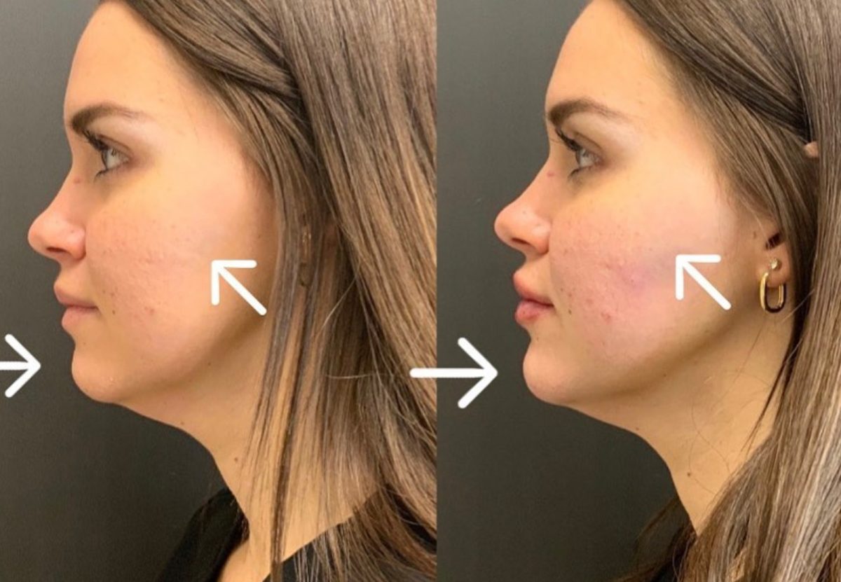Chin & Cheek Dermal Filler: before and after, Facial Balancing at Chin Up Aesthetics