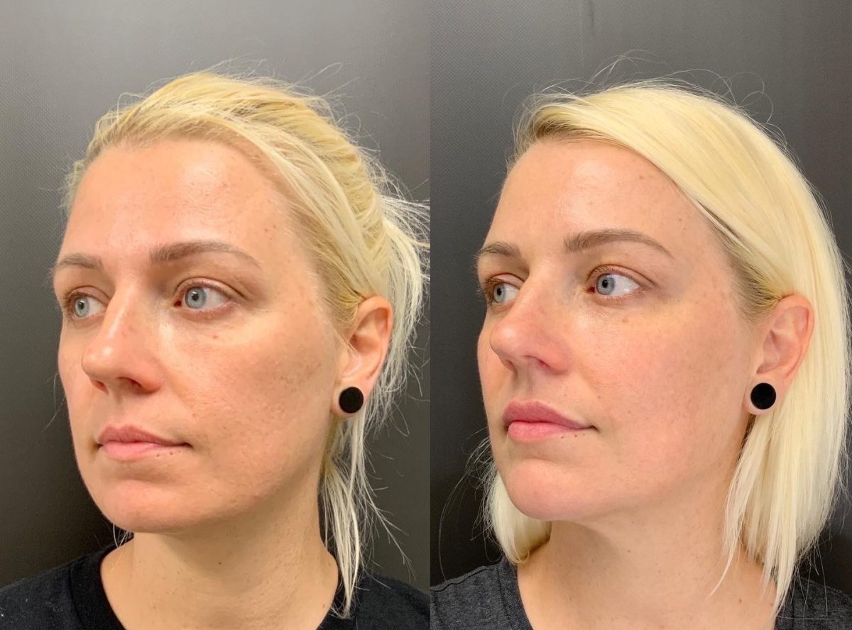 Chin & Cheeks: before and after, Facial Balancing at Chin Up Aesthetics