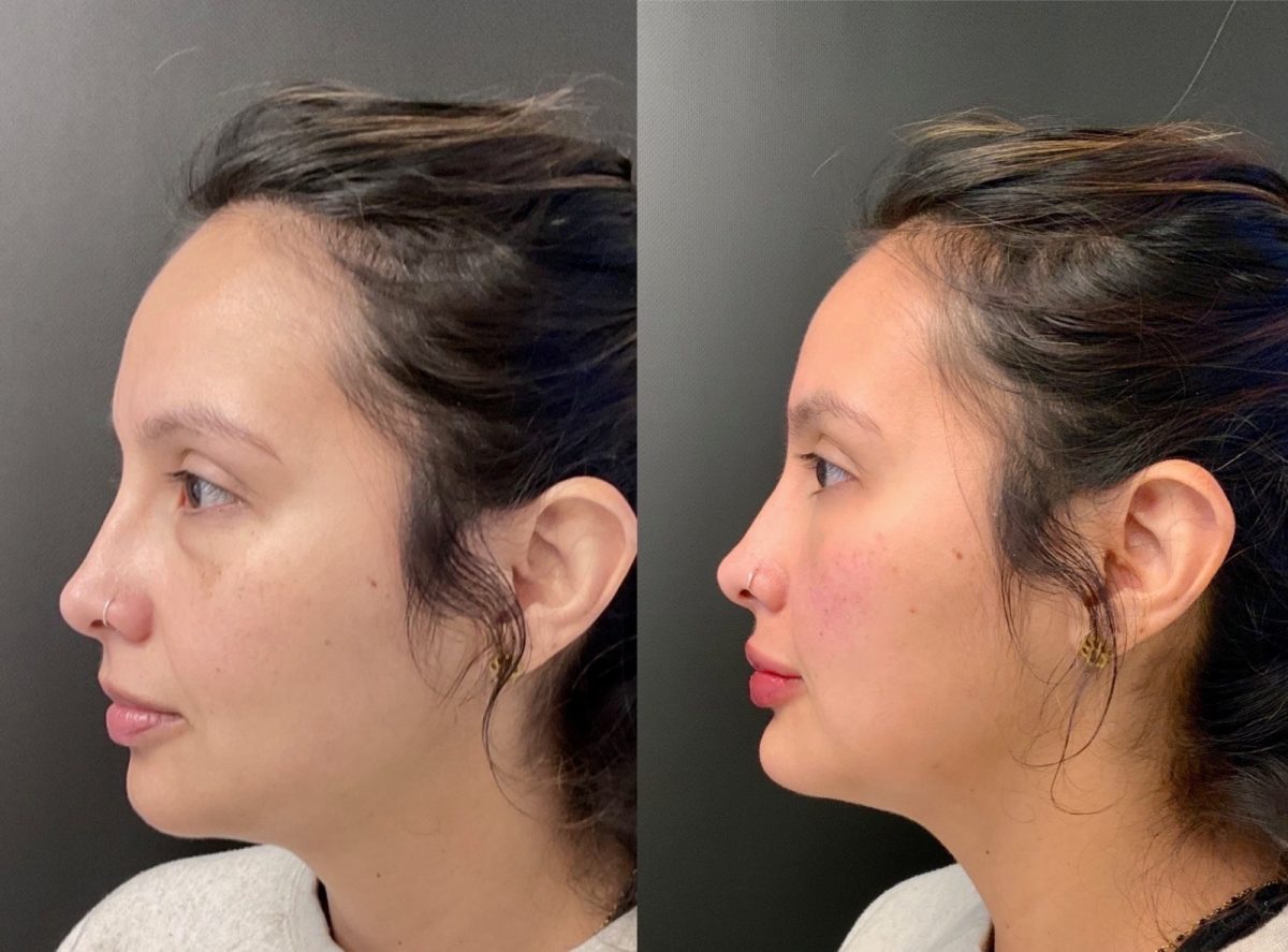 Chin & Cheeks: before and after, Facial Balancing at Chin Up Aesthetics
