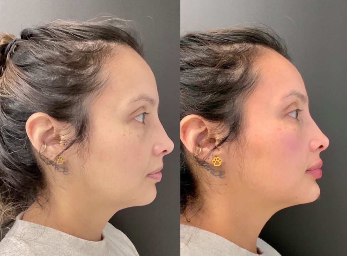 Chin & Cheeks w/ Dermal Fillers: before and after, Facial Balancing at Chin Up Aesthetics