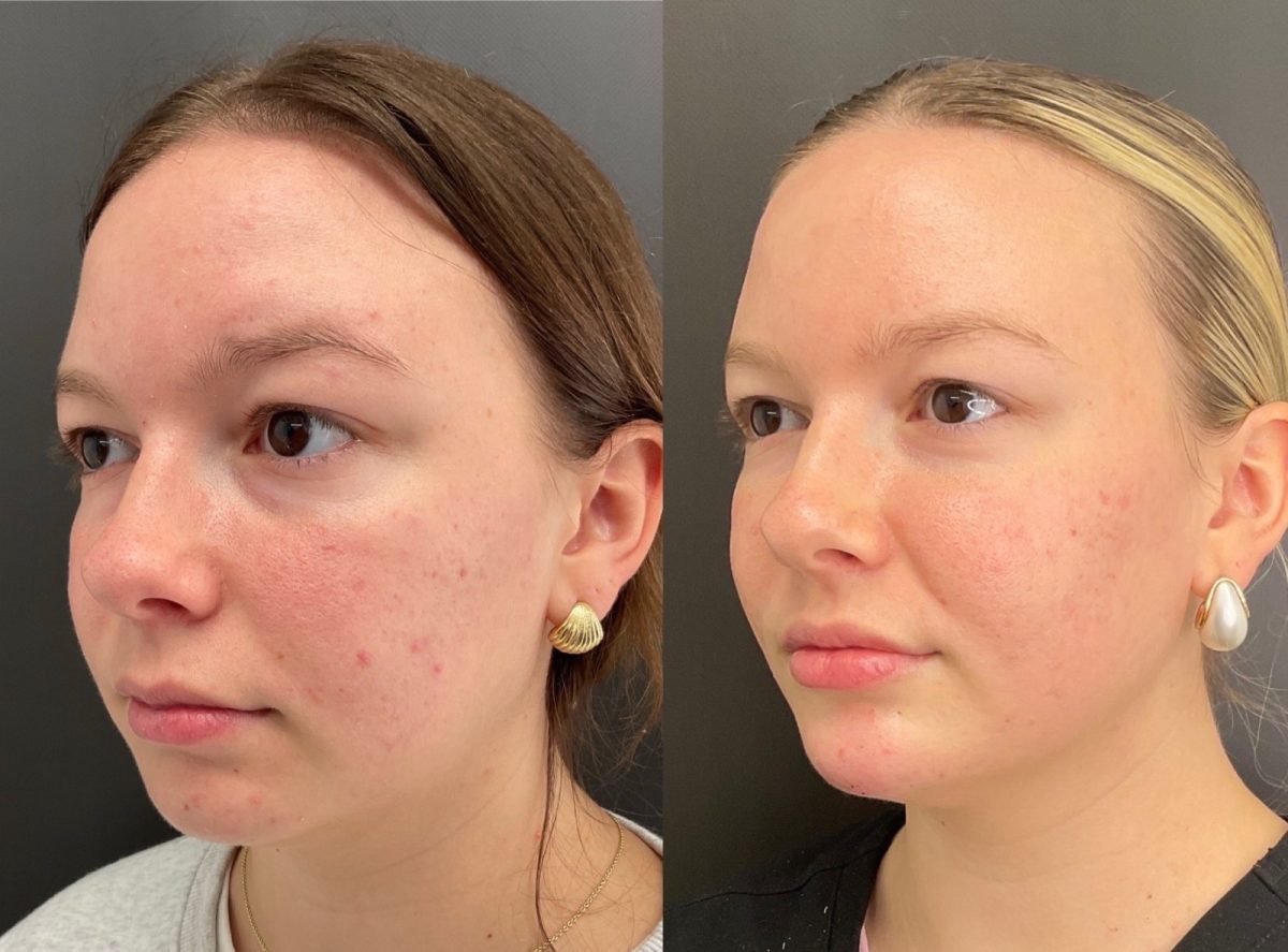 Chin & Cheeks w/ dermal filler: before and after, Facial Balancing at Chin Up Aesthetics