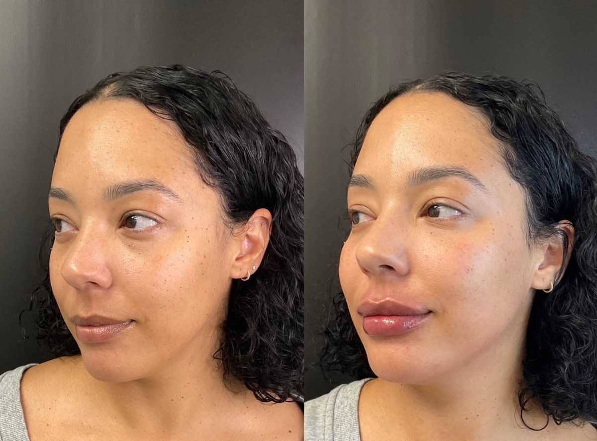 Chin & Cheeks w/ dermal filler: before and after, Facial Balancing at Chin Up Aesthetics