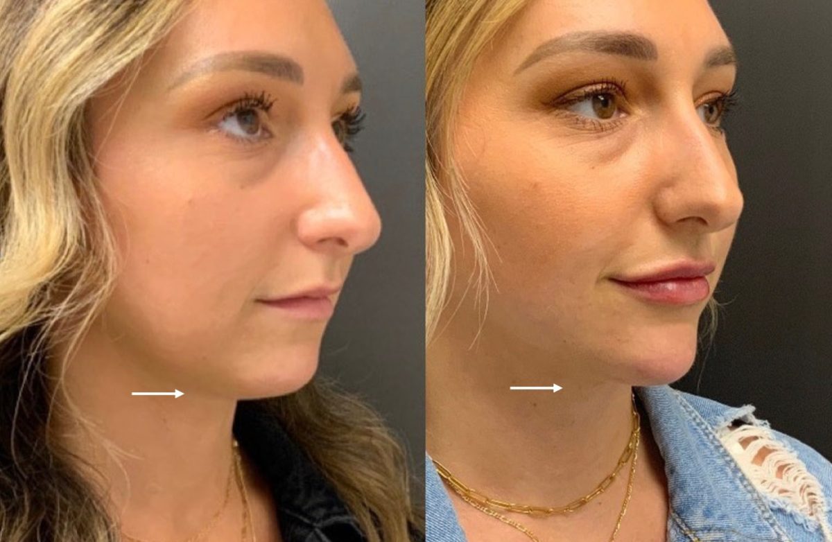 Kybella & Chin Filler: before and after, Facial Balancing at Chin Up Aesthetics