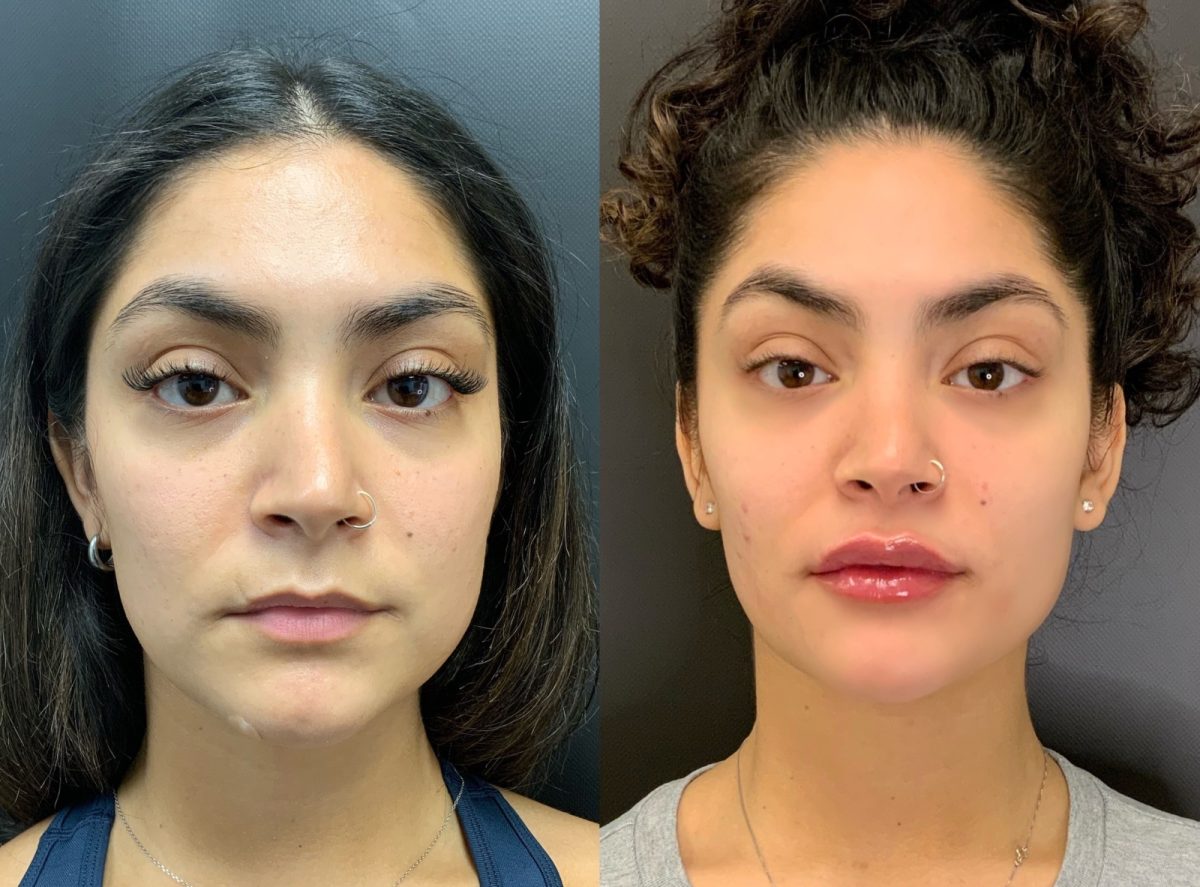 Lip Filler: before and after, Facial Balancing at Chin Up Aesthetics